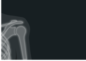 X-ray of shoulder